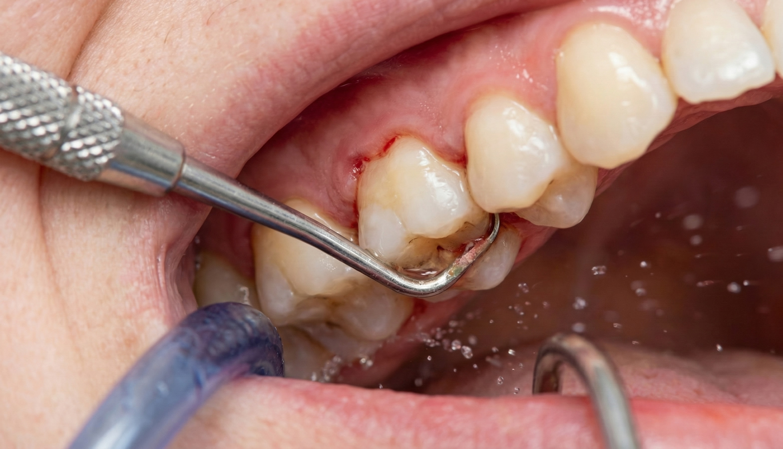 Küretaj (Derin Diş Taşı Temizliği)