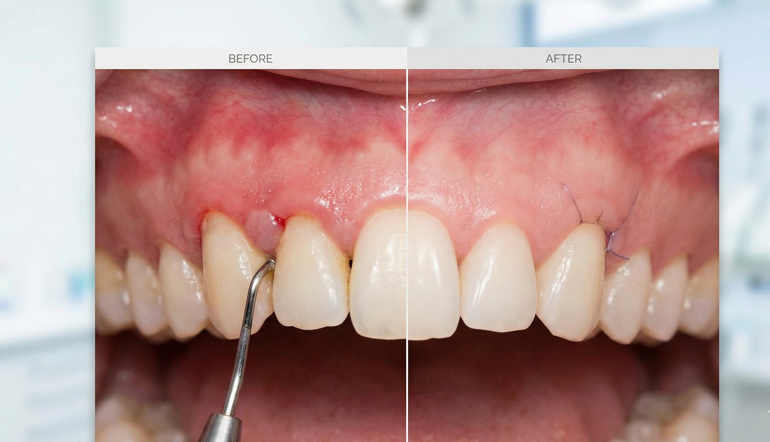 Flap Operasyonu (Diş Eti Ameliyatı)