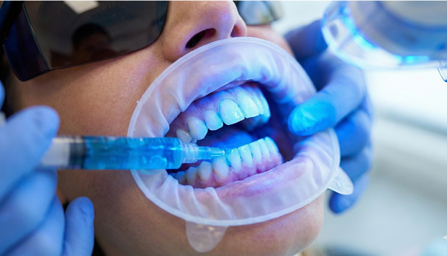   Diş Beyazlatma (Dental Beyazlatma)