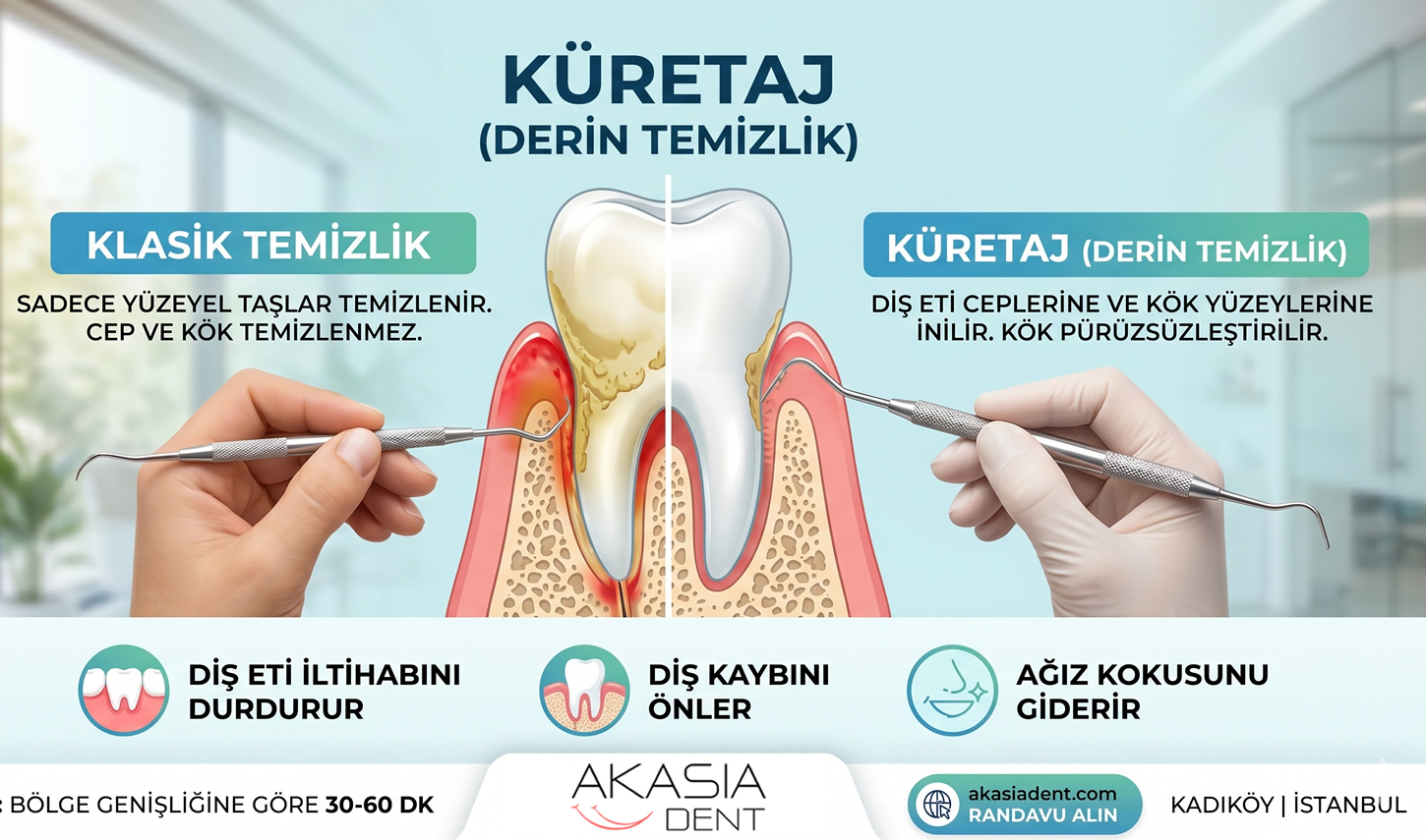 Küretaj (Derin Diş Taşı Temizliği) Nedir?